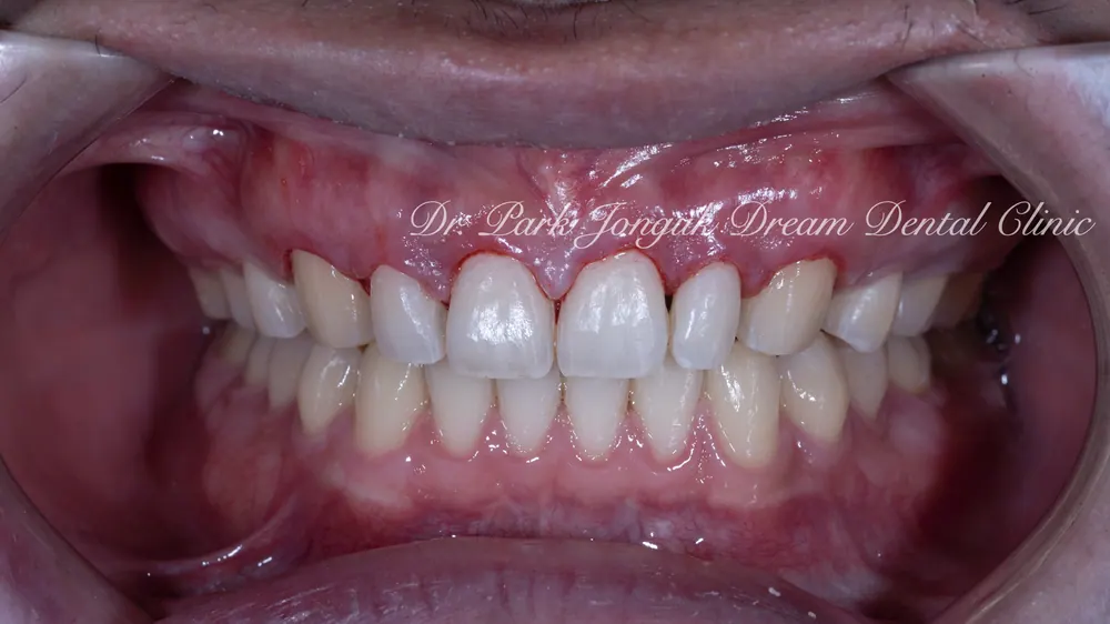 Cheongdam-dong Veneers, Done Without Any Tooth Reduction — photo 6