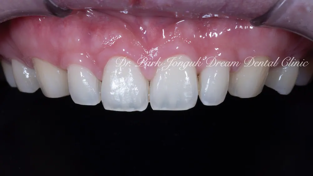 Cheongdam-dong Veneers, Done Without Any Tooth Reduction — photo 7