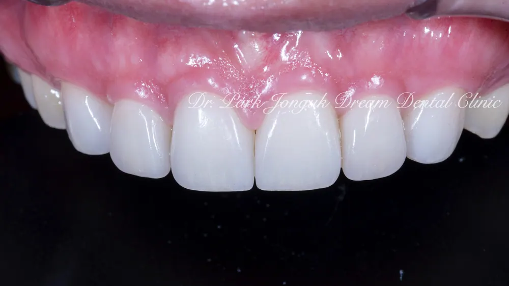 Cheongdam-dong Veneers, Done Without Any Tooth Reduction — photo 8
