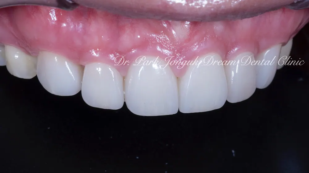 Cheongdam-dong Veneers, Done Without Any Tooth Reduction — photo 9