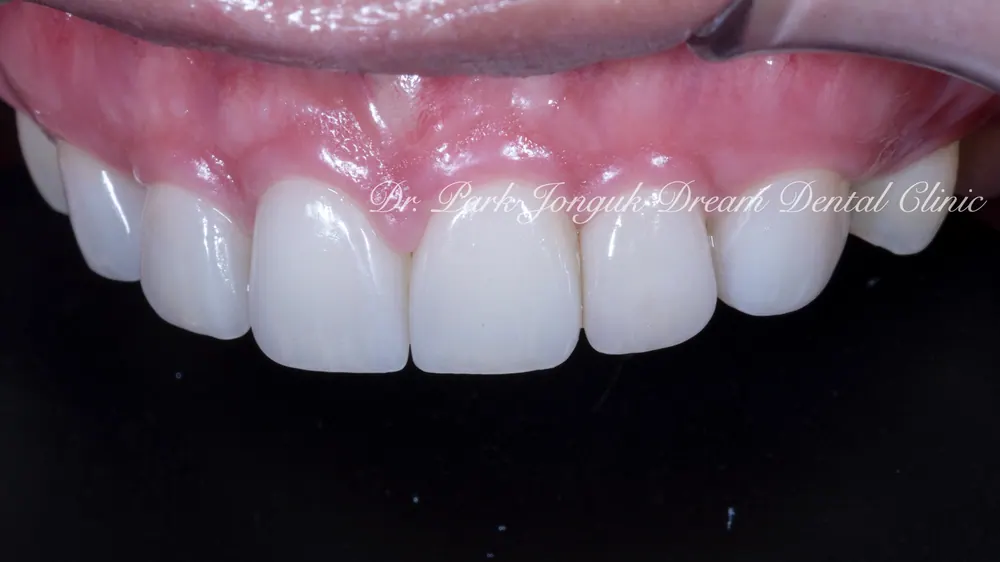 Cheongdam-dong Veneers, Done Without Any Tooth Reduction — photo 10