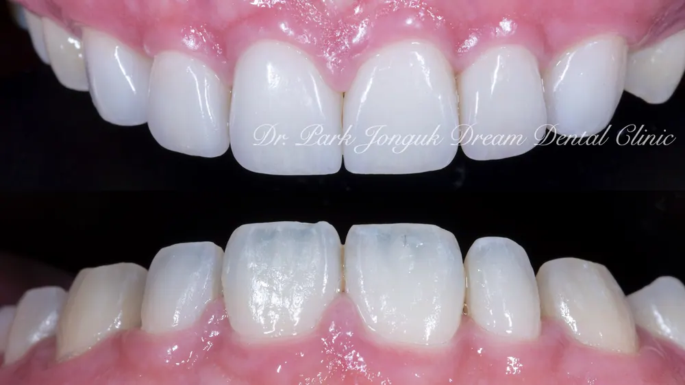 Cheongdam-dong Veneers, Done Without Any Tooth Reduction — photo 11