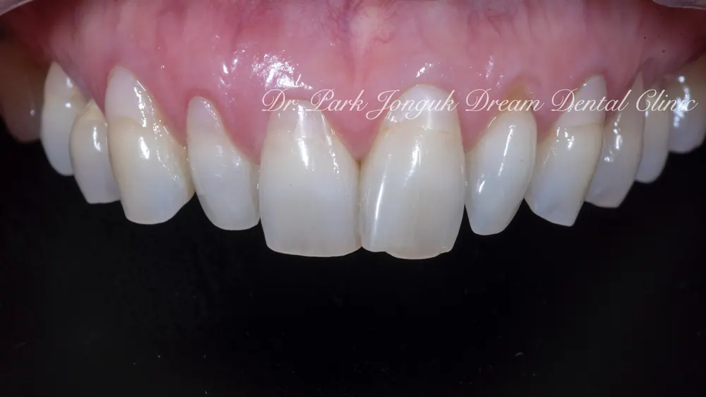 ChatGPT and Veneer Treatment — photo 1