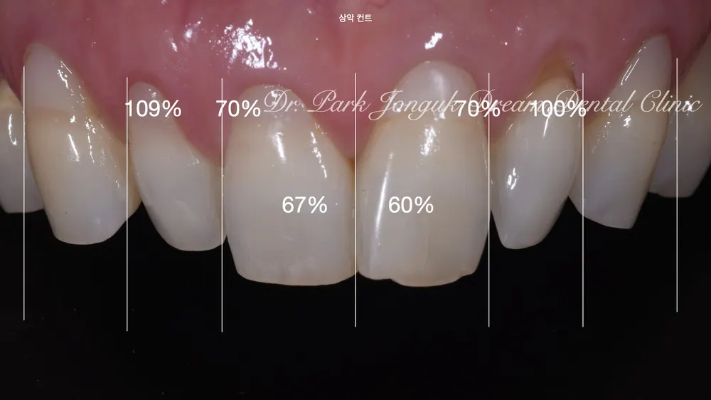 ChatGPT and Veneer Treatment — photo 2
