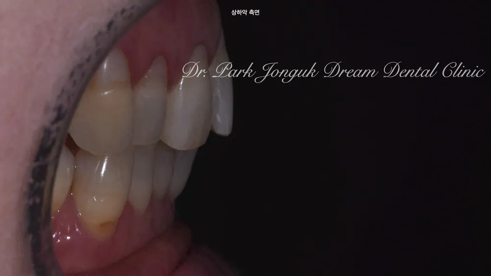 ChatGPT and Veneer Treatment — photo 3