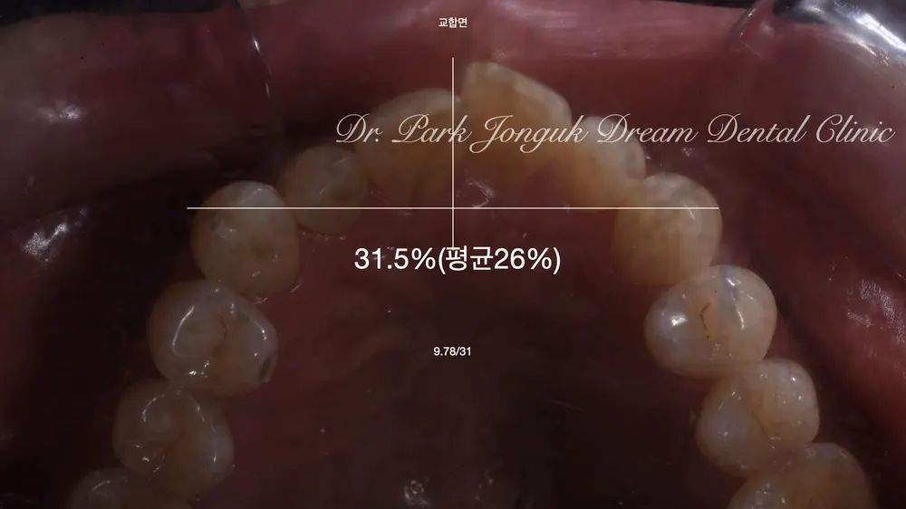 ChatGPT and Veneer Treatment — photo 4