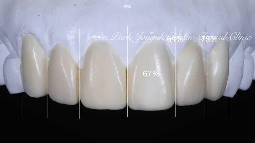 ChatGPT and Veneer Treatment — photo 5