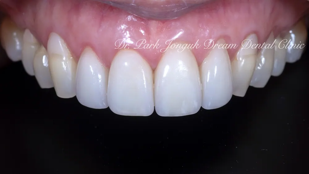 ChatGPT and Veneer Treatment — photo 6