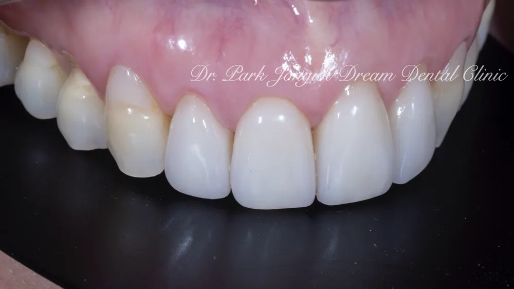 ChatGPT and Veneer Treatment — photo 7