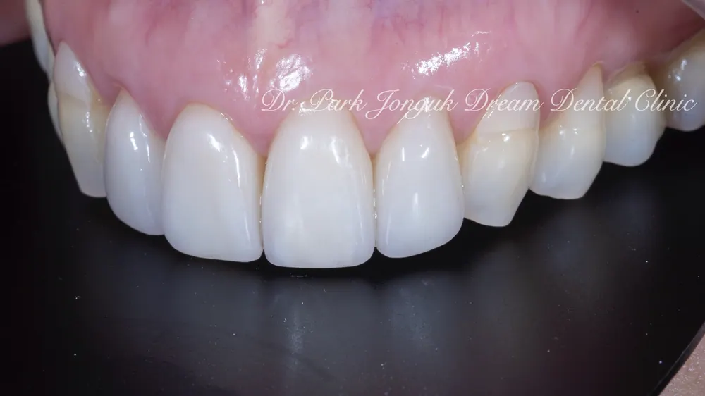ChatGPT and Veneer Treatment — photo 8