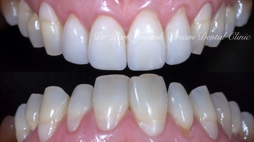 ChatGPT and Veneer Treatment — photo 9