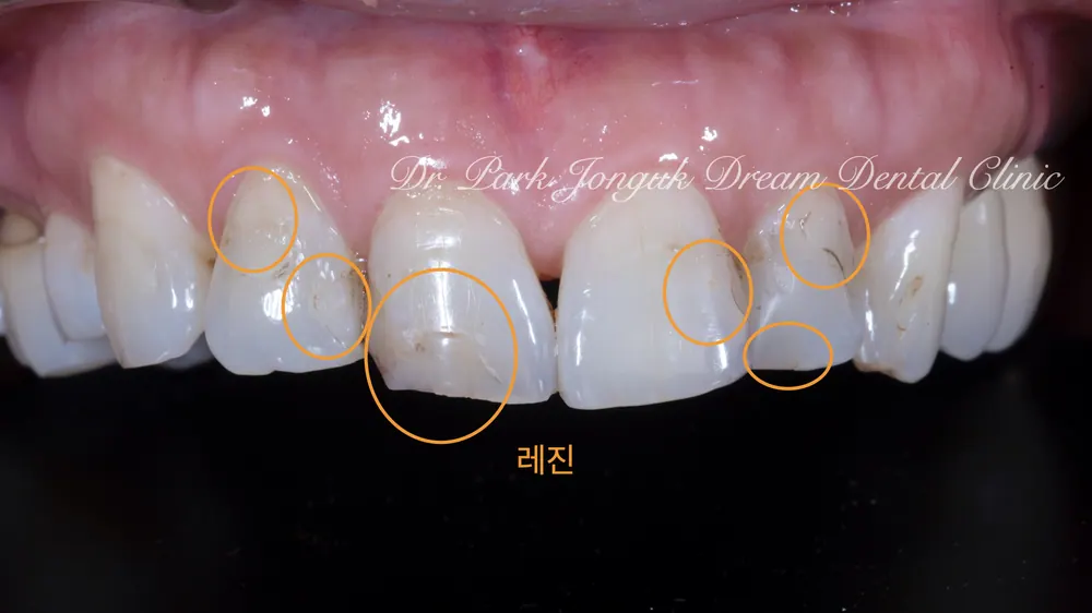 앞니라미네이트 변색된 레진과 깨진 치아의 라미네이트 치료 본문 사진 2