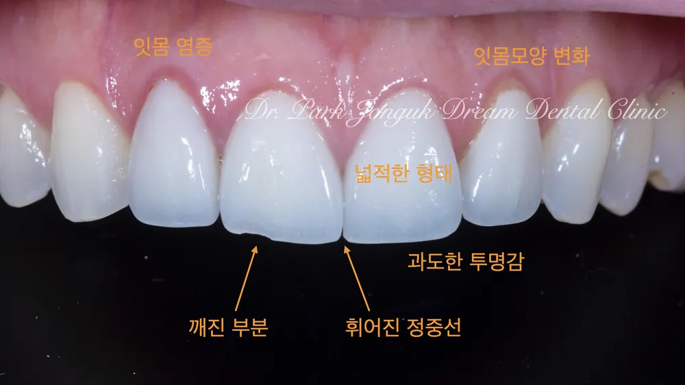 라미네이트 재시술 자연스러운 치아의 모양으로 본문 사진 2
