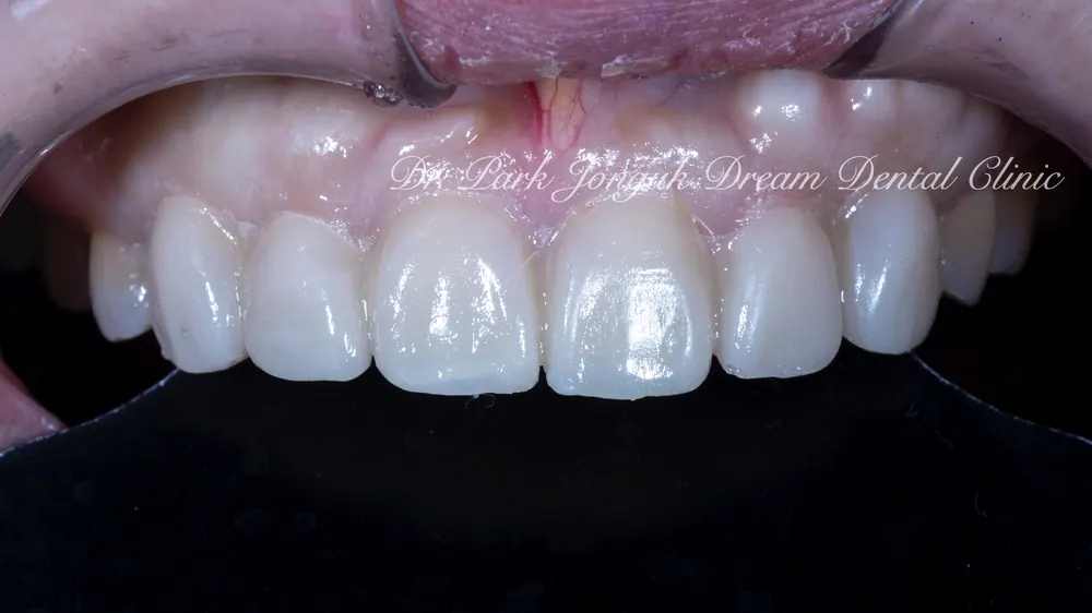 뻐드러지고 고르지 않은 치아의 최소삭제 라미네이트 본문 사진 7