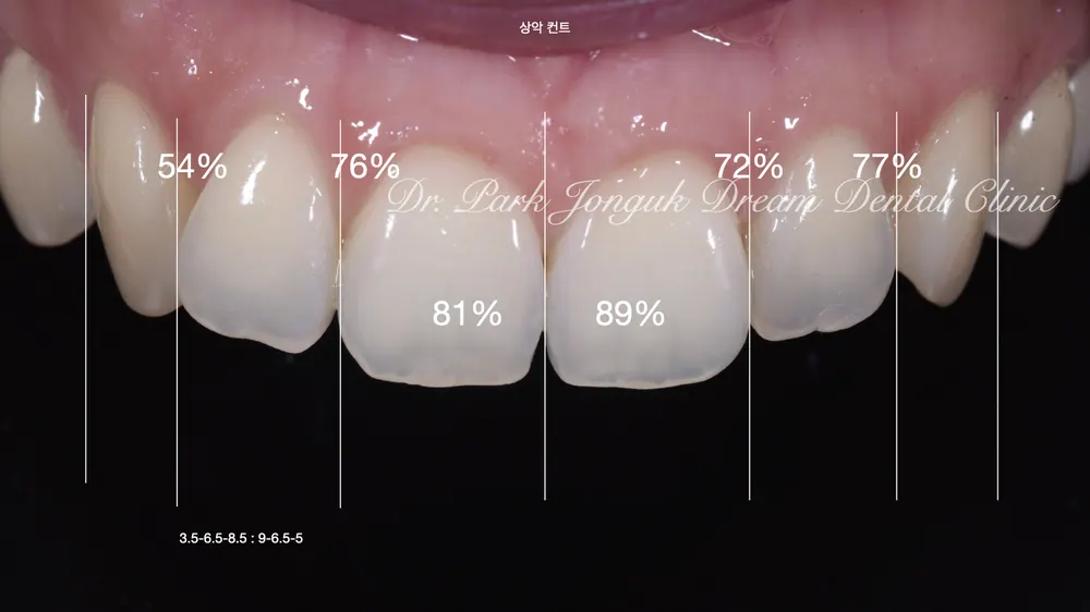 Chỉnh cả màu sắc, hình dáng lẫn hàng răng bằng veneer — ảnh 2