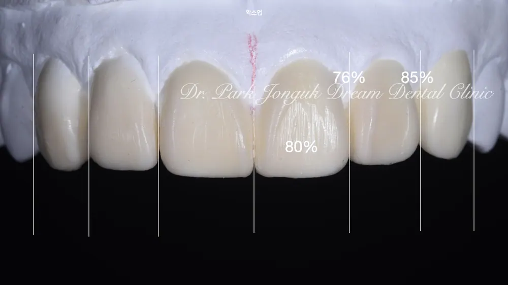 Chỉnh cả màu sắc, hình dáng lẫn hàng răng bằng veneer — ảnh 5