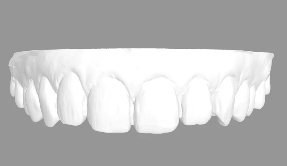 Chỉnh cả màu sắc, hình dáng lẫn hàng răng bằng veneer — ảnh 6