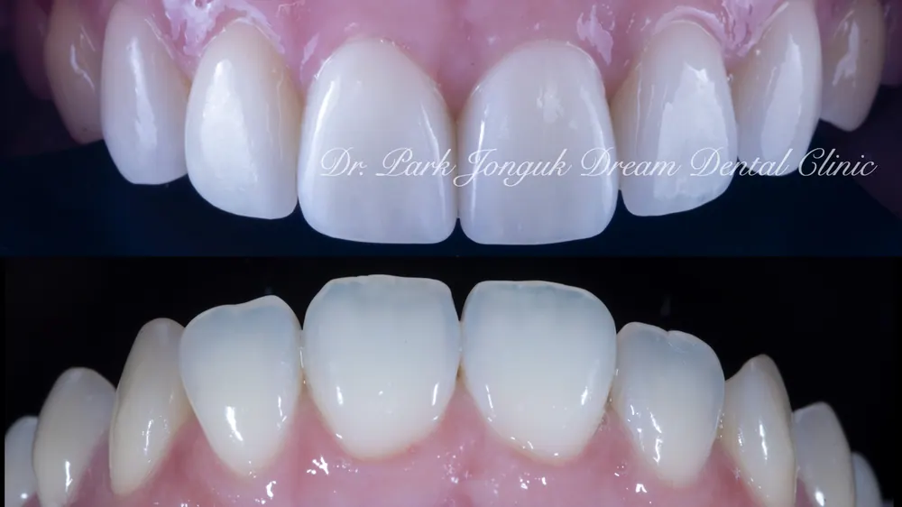 Chỉnh cả màu sắc, hình dáng lẫn hàng răng bằng veneer — ảnh 11