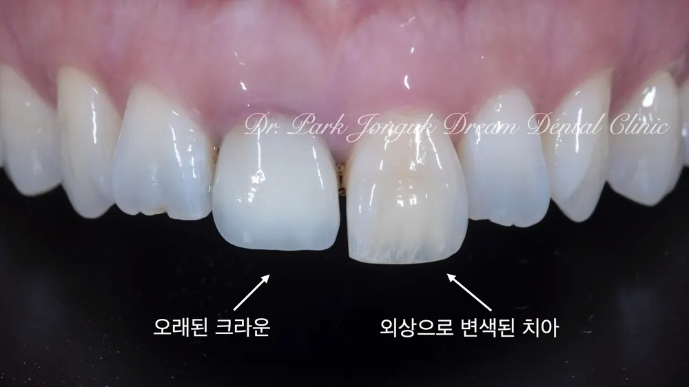 청담동라미네이트 크라운 재시술과 변색 치아의 라미네이트 치료 본문 사진 2