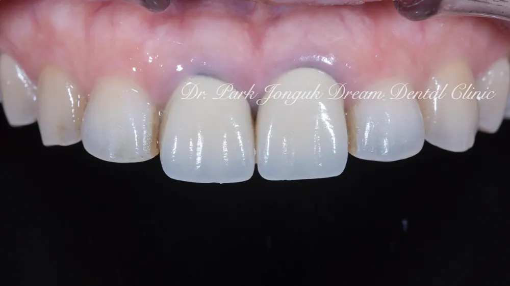 Gum Discoloration: Redoing an Old Crown That Turned the Gum Dark — photo 1