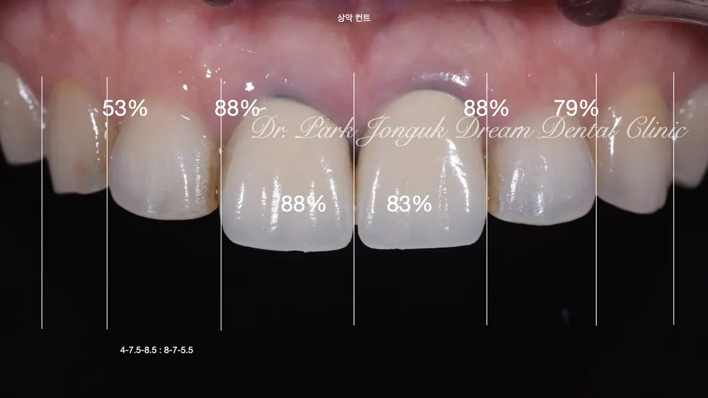 Gum Discoloration: Redoing an Old Crown That Turned the Gum Dark — photo 2