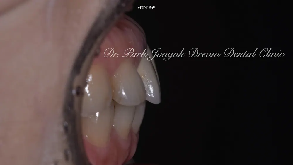 Gum Discoloration: Redoing an Old Crown That Turned the Gum Dark — photo 3