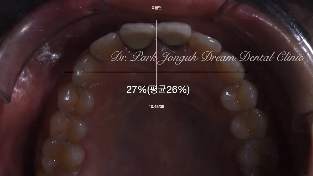 Gum Discoloration: Redoing an Old Crown That Turned the Gum Dark — photo 4