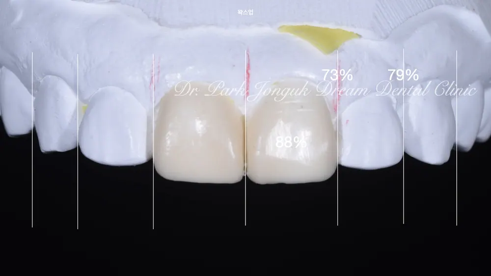 Gum Discoloration: Redoing an Old Crown That Turned the Gum Dark — photo 5