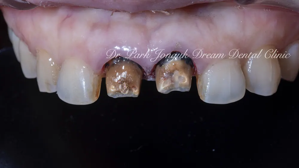 Gum Discoloration: Redoing an Old Crown That Turned the Gum Dark — photo 6