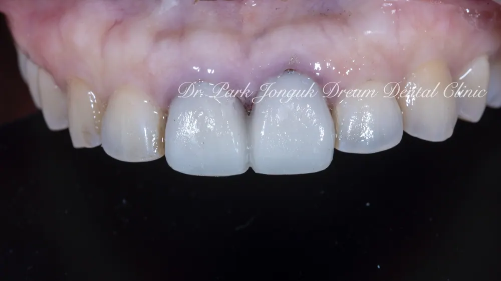 Gum Discoloration: Redoing an Old Crown That Turned the Gum Dark — photo 7