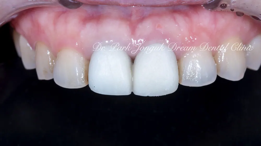 Gum Discoloration: Redoing an Old Crown That Turned the Gum Dark — photo 8
