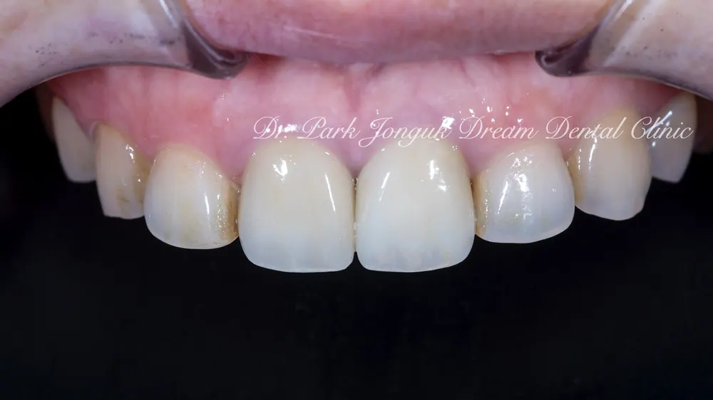 Gum Discoloration: Redoing an Old Crown That Turned the Gum Dark — photo 9