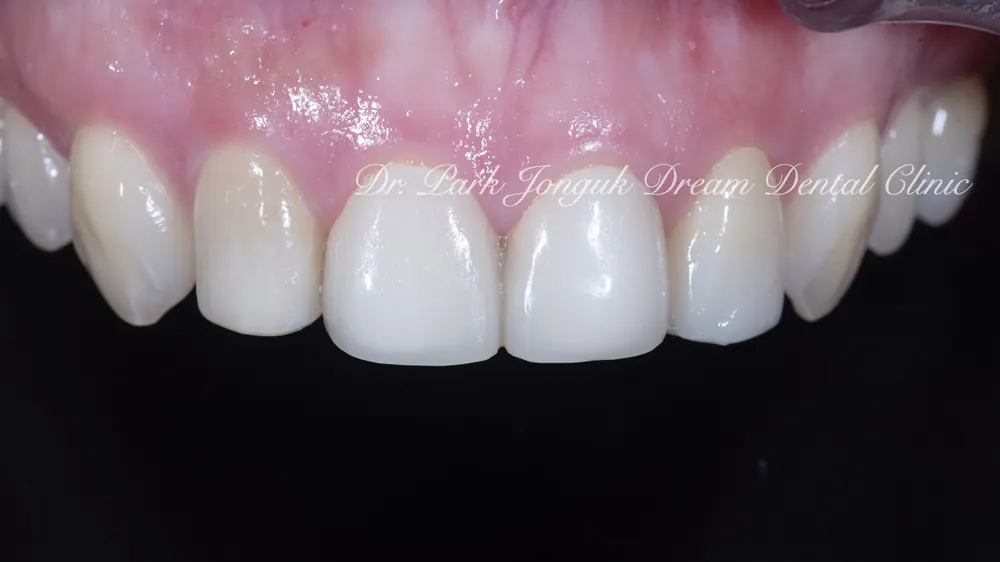 강남라미네이트 어색한 라미네이트의 재시술 본문 사진 1