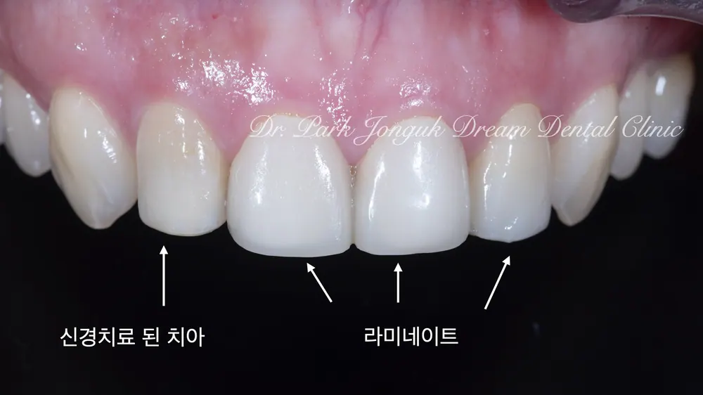 강남라미네이트 어색한 라미네이트의 재시술 본문 사진 2