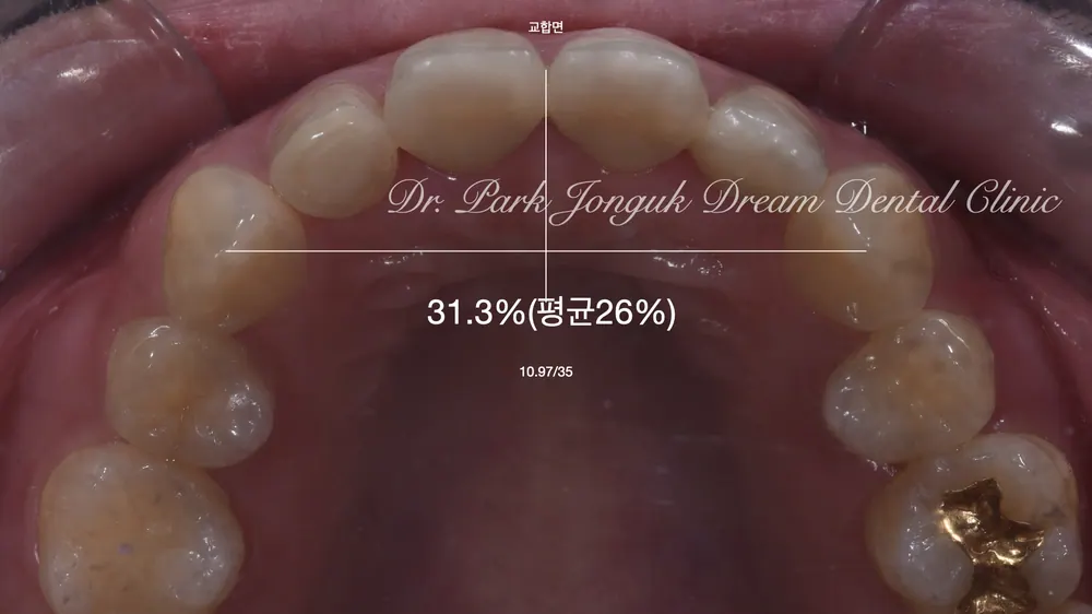 강남라미네이트 어색한 라미네이트의 재시술 본문 사진 5