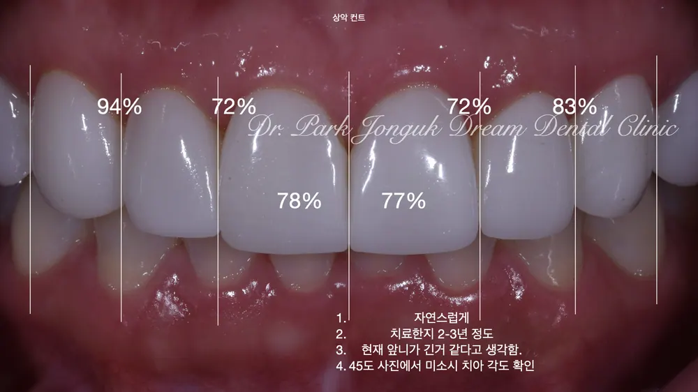 인공적인 라미네이트를 자연스러운 라미네이트로 재시술 1부 본문 사진 2