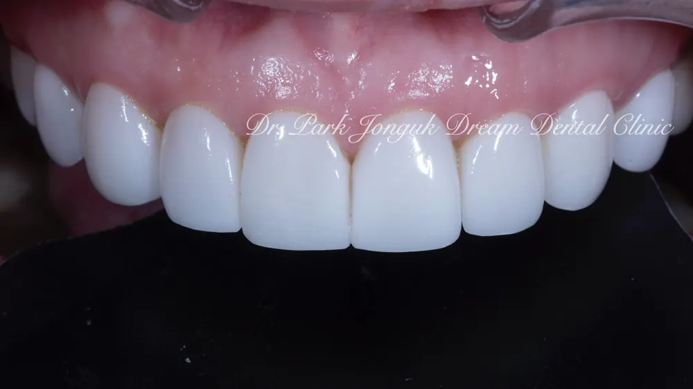 Phục hình lại dán sứ Veneer nhân tạo thành dán sứ Veneer tự nhiên - Phần 2 — ảnh 2