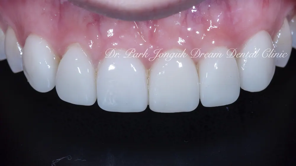 Phục hình lại dán sứ Veneer nhân tạo thành dán sứ Veneer tự nhiên - Phần 2 — ảnh 3