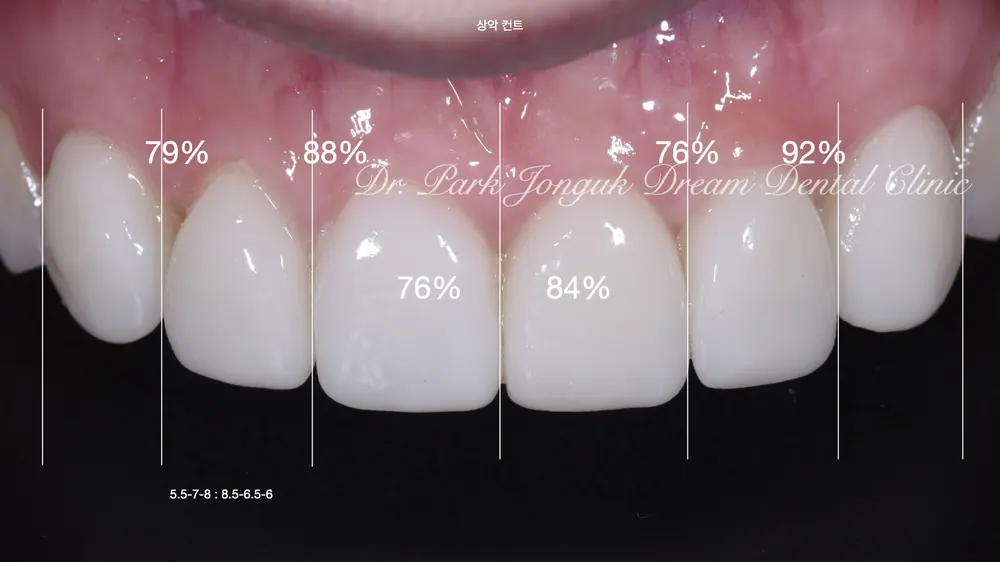 Phục hình lại dán sứ Veneer nhân tạo thành dán sứ Veneer tự nhiên - Phần 2 — ảnh 4