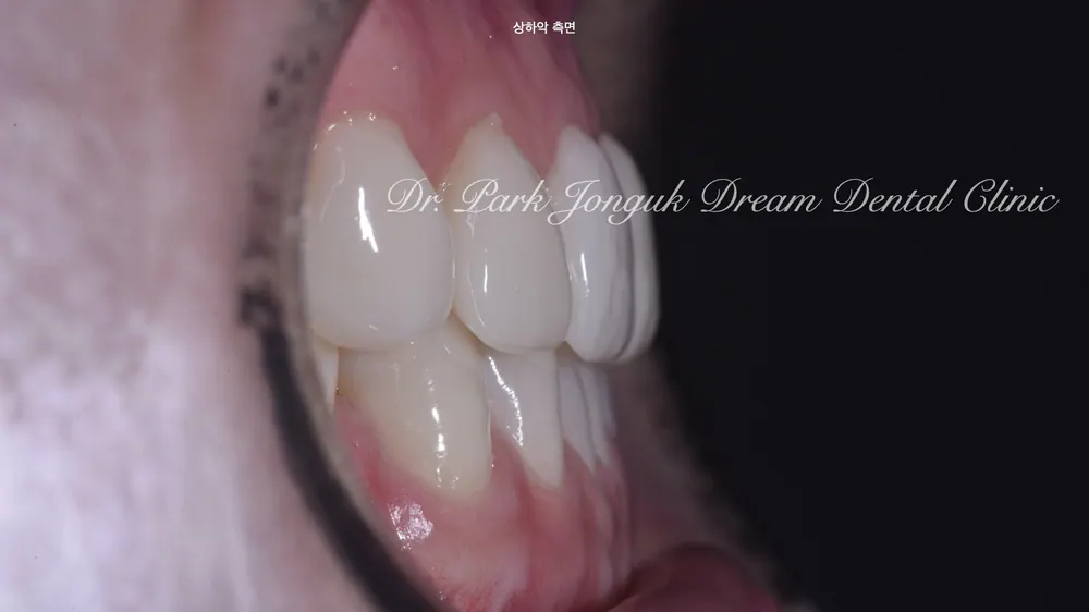 Phục hình lại dán sứ Veneer nhân tạo thành dán sứ Veneer tự nhiên - Phần 2 — ảnh 5