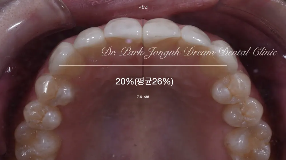 Phục hình lại dán sứ Veneer nhân tạo thành dán sứ Veneer tự nhiên - Phần 2 — ảnh 6