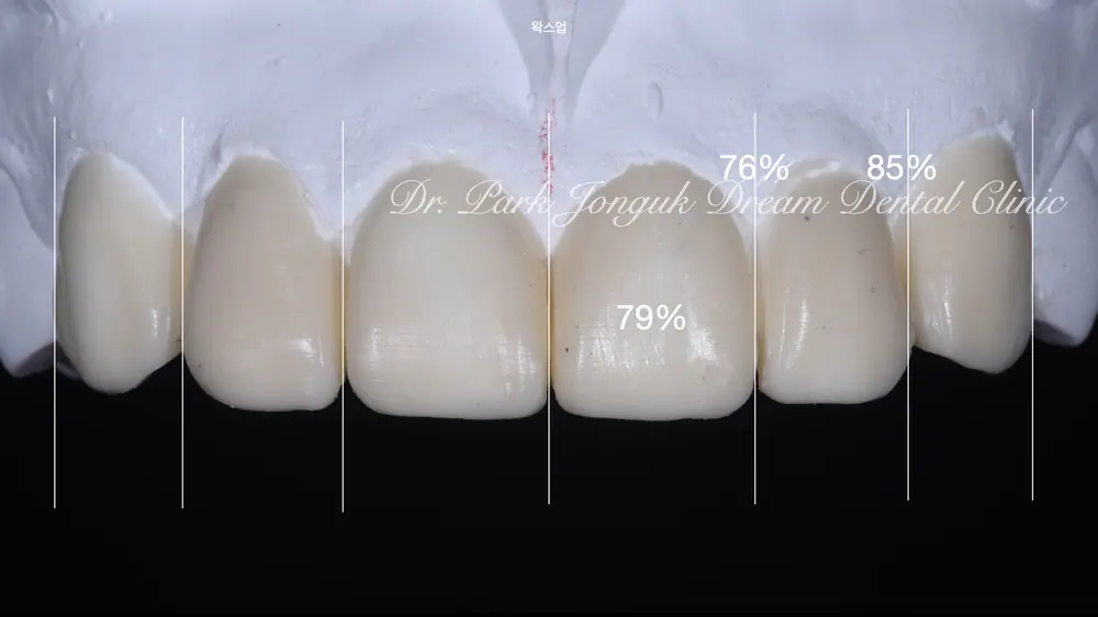 Phục hình lại dán sứ Veneer nhân tạo thành dán sứ Veneer tự nhiên - Phần 2 — ảnh 7
