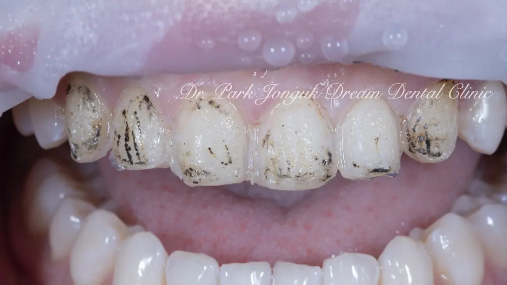 Phục hình lại dán sứ Veneer nhân tạo thành dán sứ Veneer tự nhiên - Phần 2 — ảnh 8
