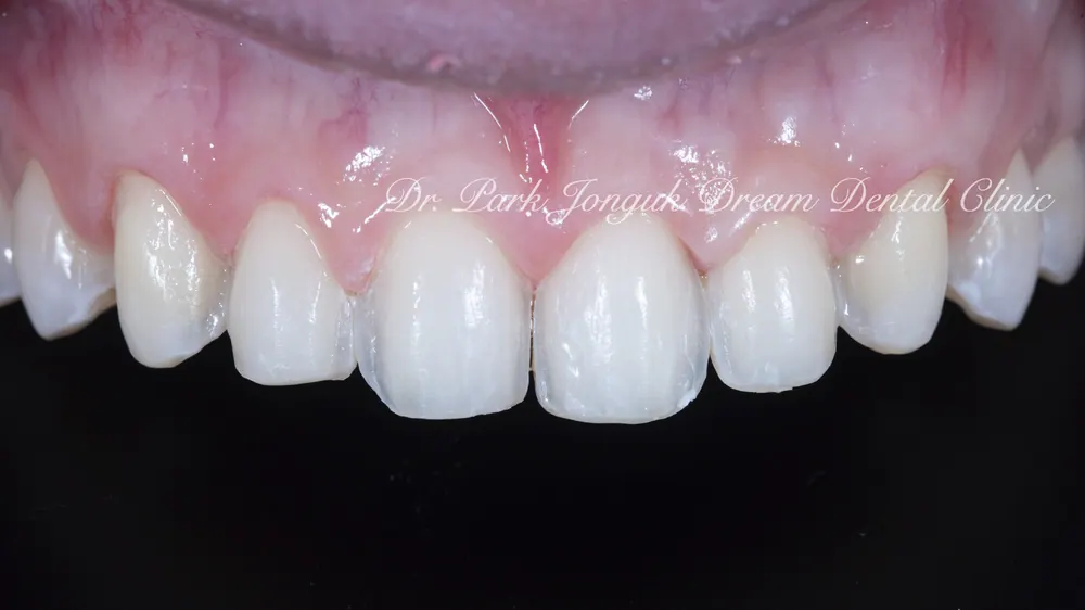 Phục hình lại dán sứ Veneer nhân tạo thành dán sứ Veneer tự nhiên - Phần 2 — ảnh 9