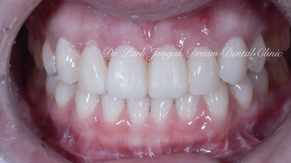Phục hình lại dán sứ Veneer nhân tạo thành dán sứ Veneer tự nhiên - Phần 2 — ảnh 10
