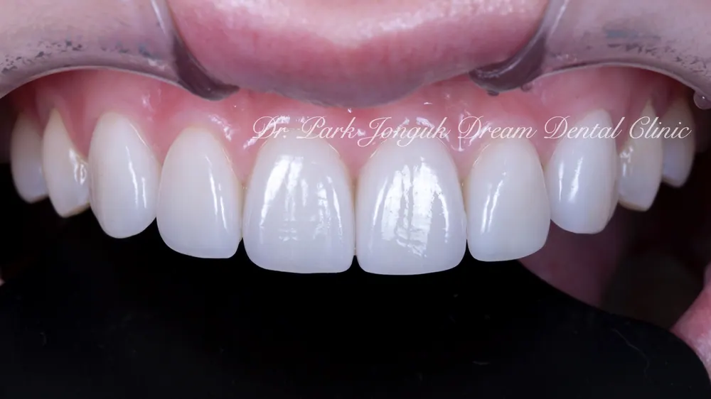 Phục hình lại dán sứ Veneer nhân tạo thành dán sứ Veneer tự nhiên - Phần 2 — ảnh 11