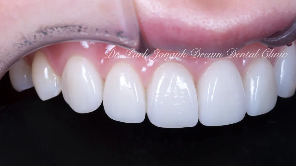 Phục hình lại dán sứ Veneer nhân tạo thành dán sứ Veneer tự nhiên - Phần 2 — ảnh 12