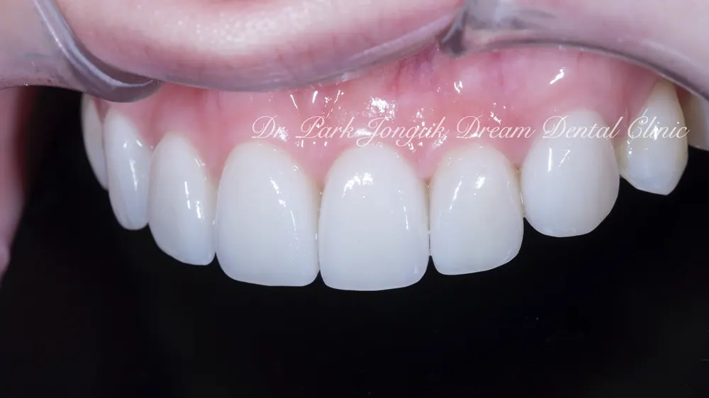 Phục hình lại dán sứ Veneer nhân tạo thành dán sứ Veneer tự nhiên - Phần 2 — ảnh 13