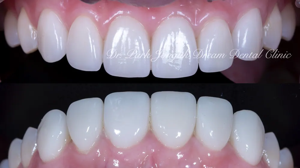 Phục hình lại dán sứ Veneer nhân tạo thành dán sứ Veneer tự nhiên - Phần 2 — ảnh 14