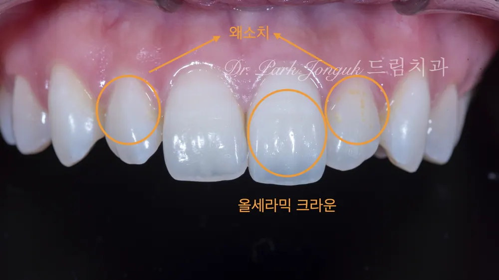 왜소치와 너무 큰 치아에 대한 앞니 라미네이트 치료 본문 사진 2